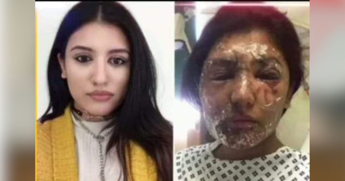 Unveiling the Truth Behind the Acid Attack on Resham Khan